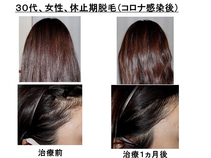 円形脱毛症　病院